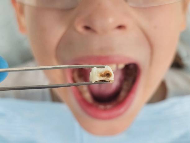 Best Emergency Treatment for Dental Infections or Abscesses in Penbrook, PA